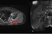 The piriformis abscess: a case-based review